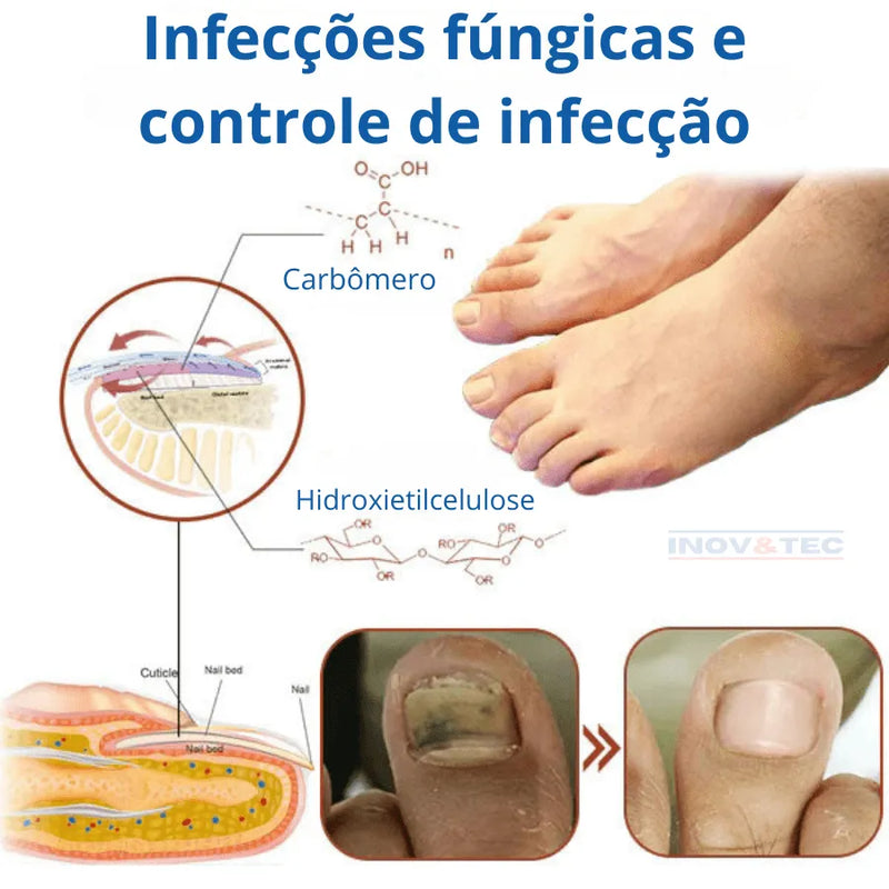 Dispositivo De FotoTerapia Ultra Violeta FreshNail - Tratamento Eficiente Para Doenças e Fungos De Unhas [QUEIMA DE ESTOQUE ULTIMAS UNIDADES - 50% De Desconto]