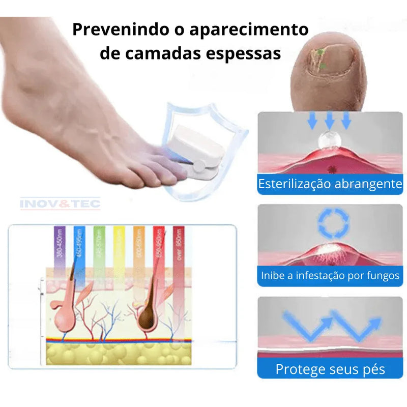 Dispositivo De FotoTerapia Ultra Violeta FreshNail - Tratamento Eficiente Para Doenças e Fungos De Unhas [QUEIMA DE ESTOQUE ULTIMAS UNIDADES - 50% De Desconto]