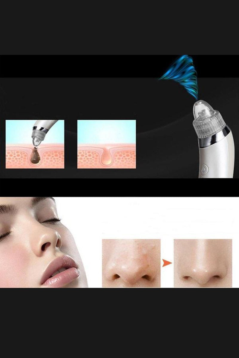 Aparelho Removedor de Cravos a Vácuo - MicroDerm