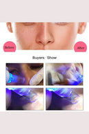 Aparelho Removedor de Cravos a Vácuo - MicroDerm