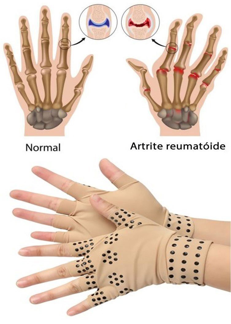 Luvas Magnéticas Terapêutica Anti-Artrite, Carpo, Tendinite e Reumatoide